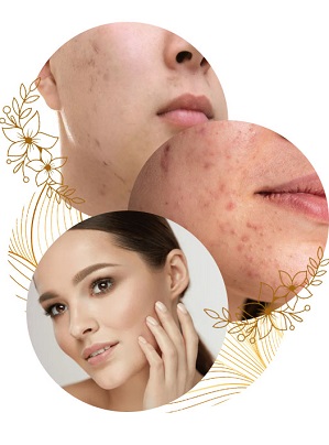 Facial Scar Revision in Islamabad