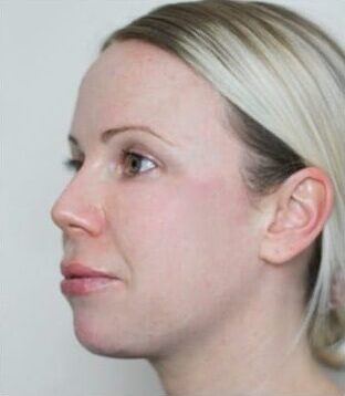 Jawline Fillers Injections Price in Islamabad