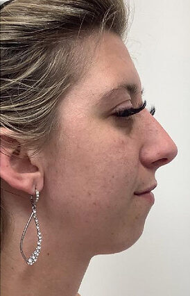 Jawline Fillers Injections Price in Islamabad Pakistan