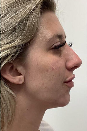 Jawline Fillers Injections Price in Islamabad Pakistan