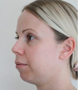 Jawline Fillers Injections Price in Islamabad