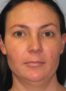 Pigmentation Treatment Cost in Islamabad Pakistan