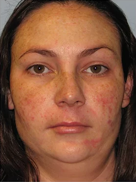 Pigmentation Treatment Cost in Islamabad Pakistan