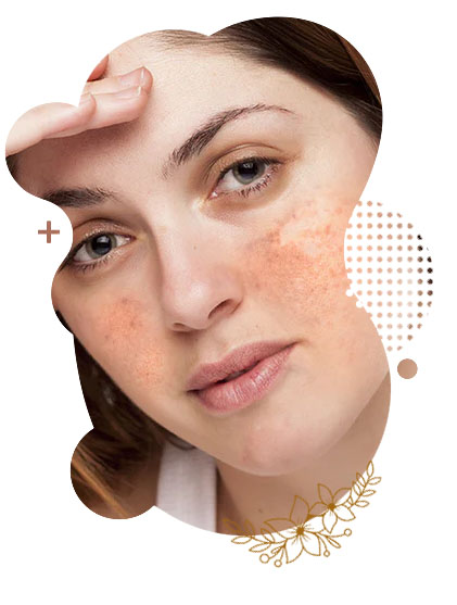 Pigmentation Treatment Price in Islamabad Pakistan