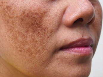 Pigmentation Treatment in Islamabad