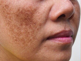 Pigmentation Treatment in Islamabad