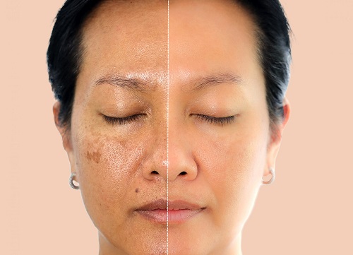 Pigmentation Treatment in Islamabad Pakistan
