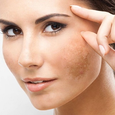 Melasma Laser Treatment Cost in Islamabad