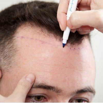 Sapphire FUE Hair Transplant in Islamabad