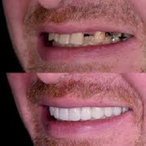 Dental Implant beore & Ater Islamabad