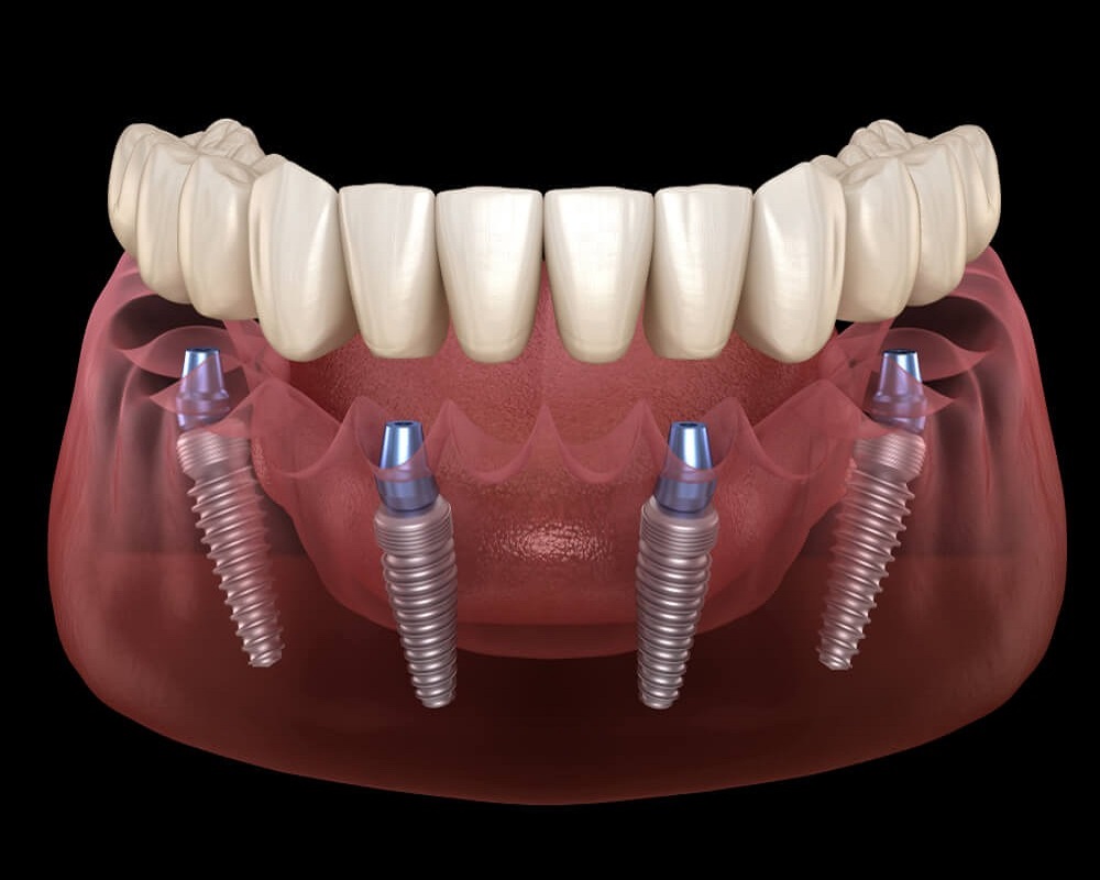 Dental Implant in Islamabad