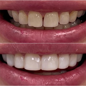 Dental Retainers before & After in Islamabad