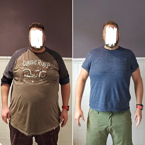 Fat Melting Injections before & After clinic in islamabad