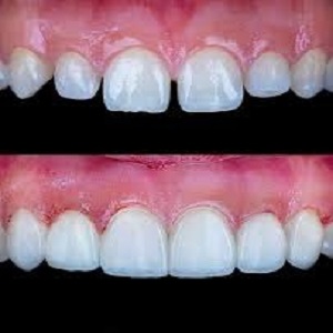Fractured Teeth Treatment before & After in islamabad