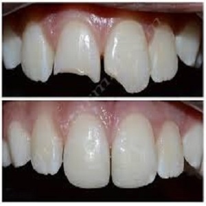 Fractured Teeth Treatment before & After islamabad