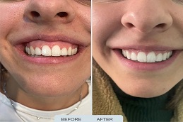 Gummy Smile Treatment before & After.