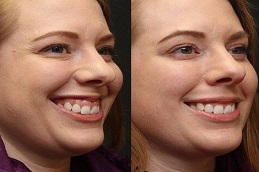 Gummy Smile Treatment before & after clinic in islamabad