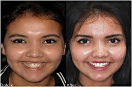 Gummy Smile Treatment before & after clinic islamabad