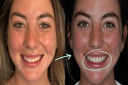Gummy Smile Treatment before & after