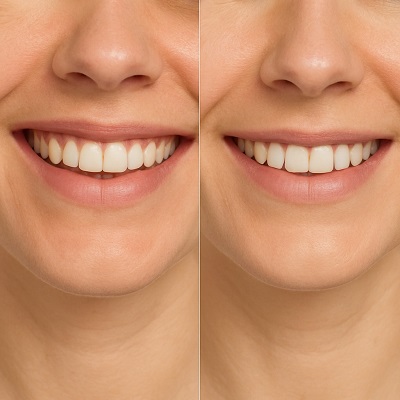 Gummy Smile Treatment in Islamabad Pakistan