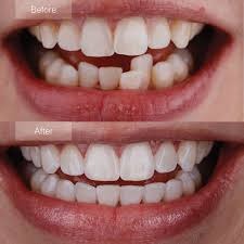 Invisalign Treatment in before & After clinic in Islamabad