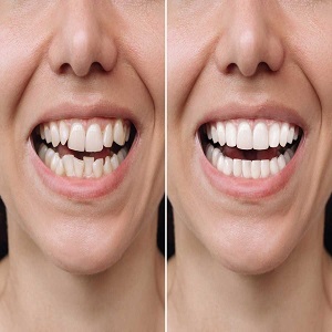 Invisalign Treatment in before & After