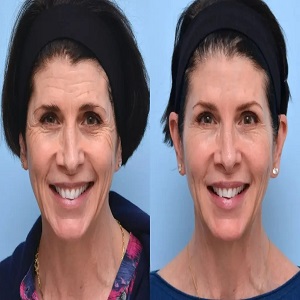 Jalupro Young Eyes before and After clinic in islamabad