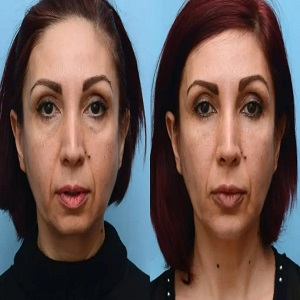 Jalupro Young Eyes before and After