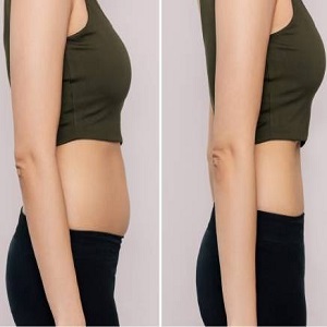 Lipolytic Injection before & After islamabad