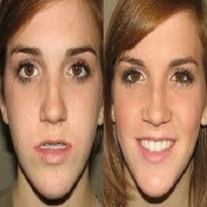 Mandibular Jaw Implants before and after in islamabad