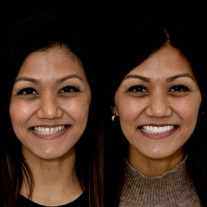Non-Prep Veneers before & After clinic Islamabad