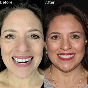 Non-Prep Veneers before & After