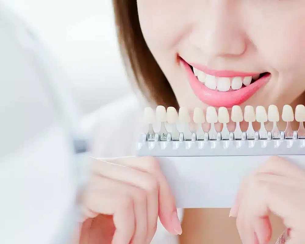 Non-Prep Veneers in Islamabad Pakistan