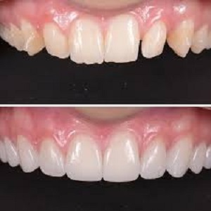 Protruding Teeth Treatment befoe & After clinic in islamabad