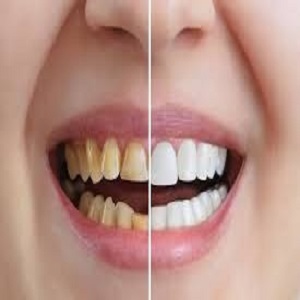 Protruding Teeth Treatment in islamabad
