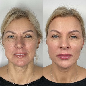 Radiesse Filler Injections before & After