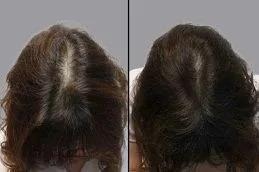 Results OF G Cell Treatment Islamabad