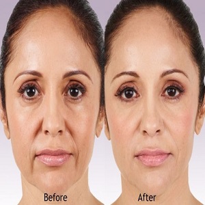 Results of Juvederm Fillers clinic Islamabad