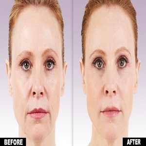 Results of Juvederm Fillers in Islamabad