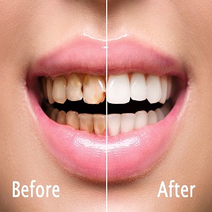 Teeth Scaling and Polishing before & After clinic Islamabad