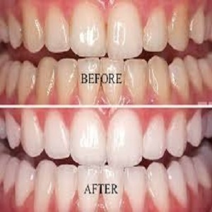 Teeth Scaling and Polishing before & After