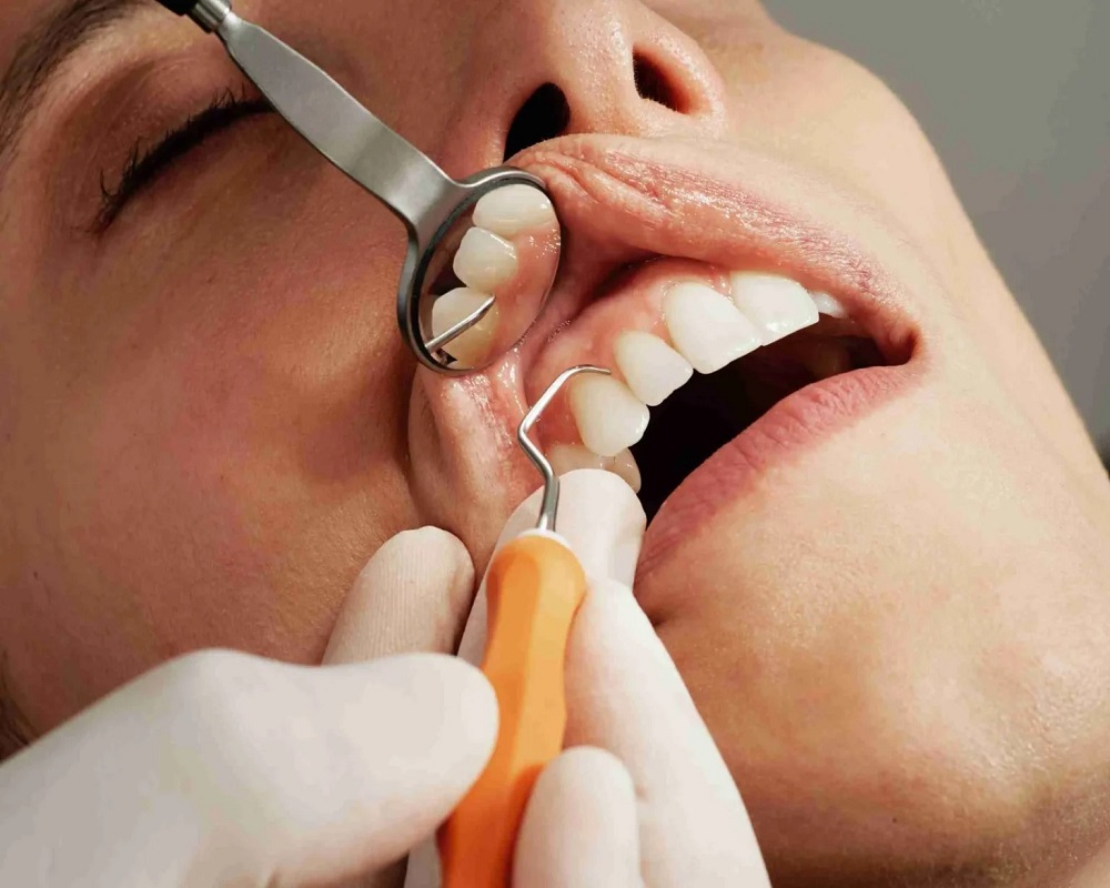 Teeth Scaling and Polishing in Islamabad Pakistan