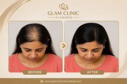 before and after result of American exosomes in Rawalpindi