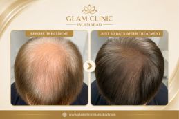 before and after result of American exosomes hair therapy in Rawalpindi Islamabad