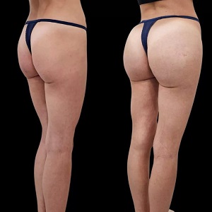 butt fillers before & after clinic in islamabad