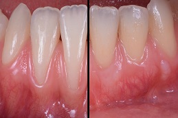gum recession treatment before & after clinic in islamabad