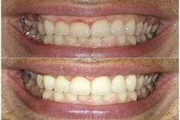gum recession treatment before & after in islamabad