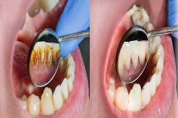 gum recession treatment before & after islamabad