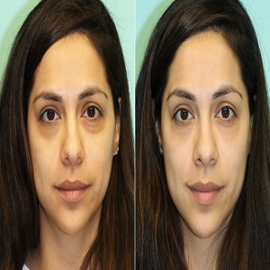 restylane fillers before and after clinic islamabad