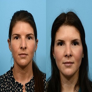 Alarplasty Before & After Islamabad